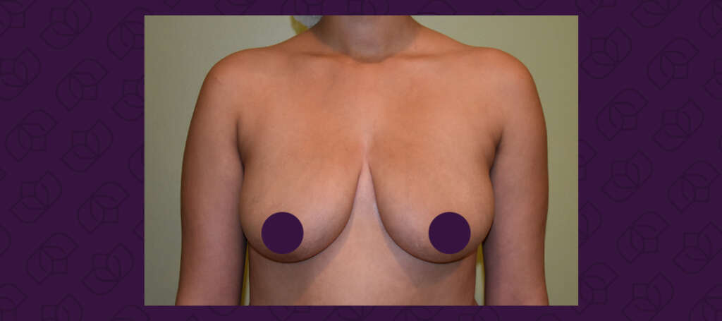 before-breastlift-01