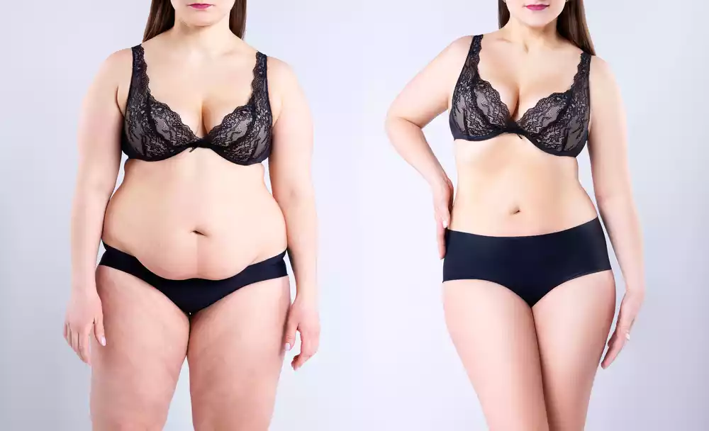 vaser liposuction