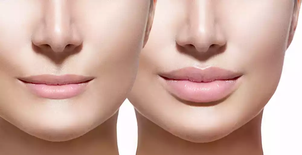 benefits of lip fillers
