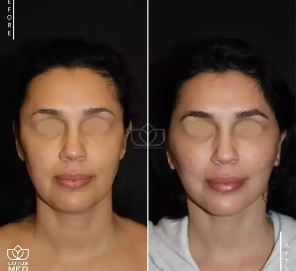 FACELIFT_Mesa de trabajo 1