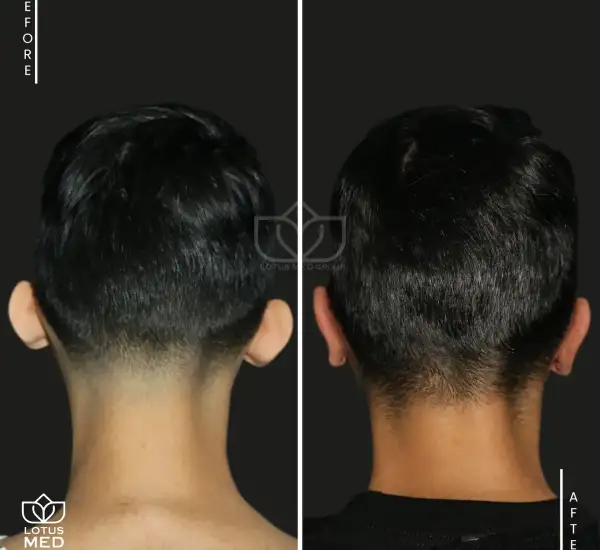 OTOPLASTIA_Mesa de trabajo 1